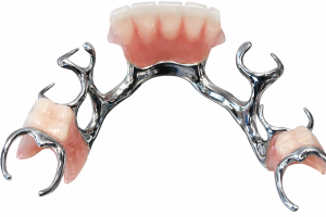 dentures or implants - chrome framework denture